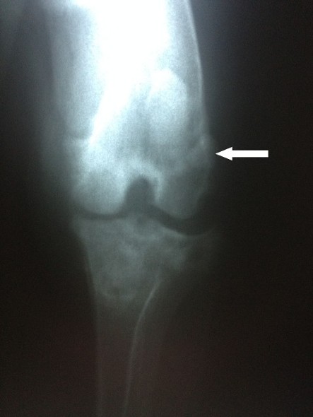 dog knee bone cancer