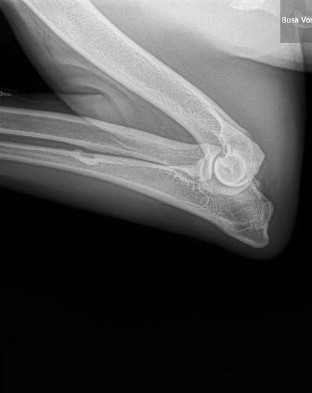 busa left lateral elbow